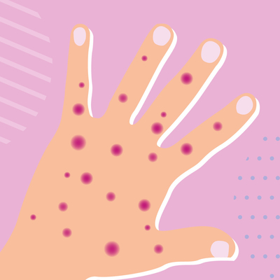 ชุดทดสอบโรคติดเชื้อแบบเรียลไทม์ PCR Monkeypox MPXV CE Registered 1 ชุดทดสอบ/กล่อง